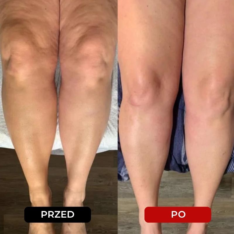 Porównanie efektów przed i po stosowaniu CelluMagia – widoczna redukcja cellulitu i gładsza skóra ud.