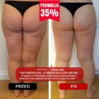 Efekt regularnych masaży CelluMagia – pewność siebie i satysfakcja z gładkiej skóry.