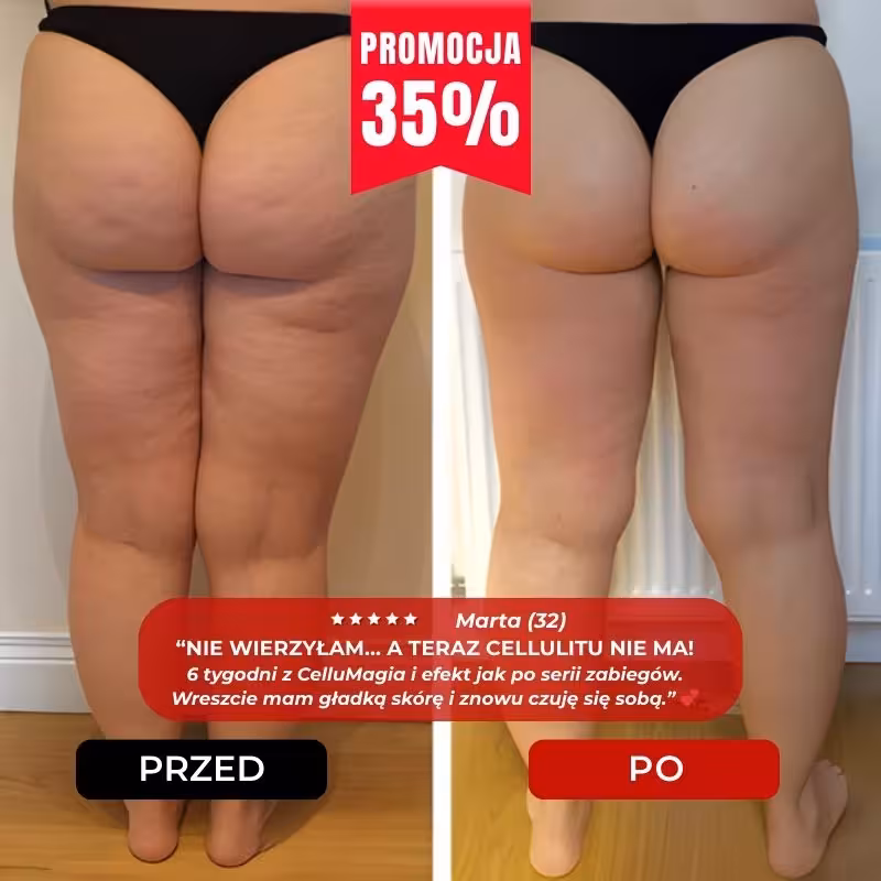 Efekt regularnych masaży CelluMagia – pewność siebie i satysfakcja z gładkiej skóry.