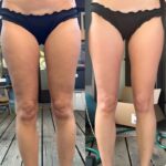 Użycie CelluMagia na udzie – masaż antycellulitowy