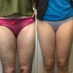 Masaż uda urządzeniem CelluMagia – efekt po zabiegu