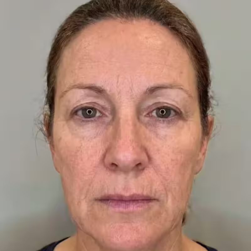 CelluRevital efekt przed i po